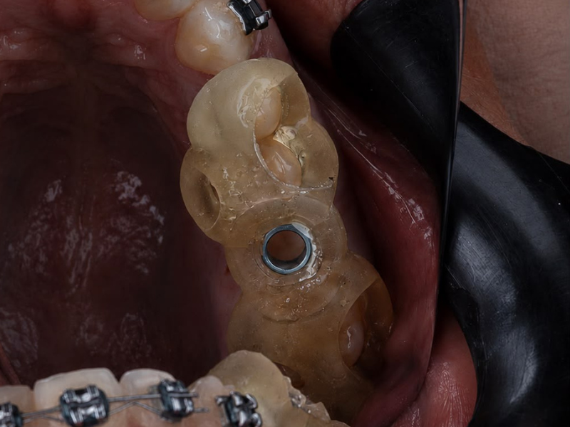 Cirurgia Guiada Executada